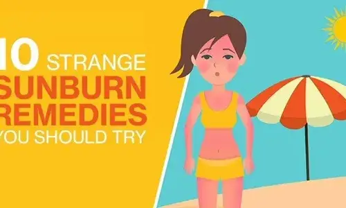 10 exotic sunburn remedies you should try