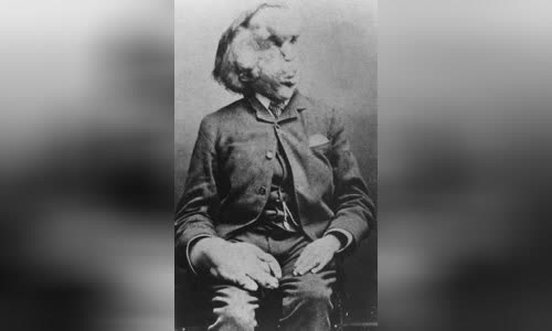 Joseph Merrick