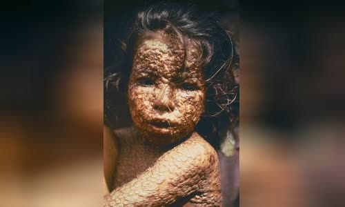 Smallpox