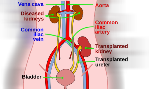 Kidney transplantation
