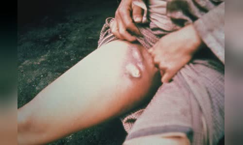 Bubonic plague