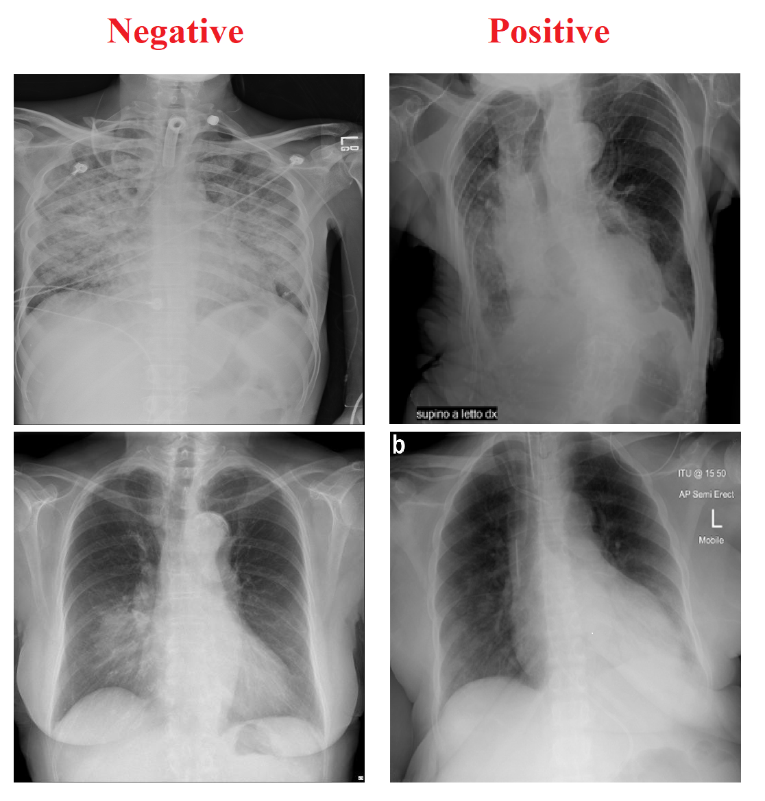 COVID-19 X-ray image classification | Kaggle