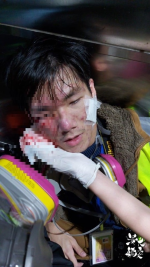 催淚彈攻擊眼部 浸大學生記者右顴骨中彈受傷