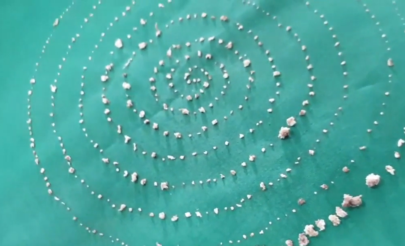 526 teeth were removed from a 7-year-old boy’s jaw in Chennai.