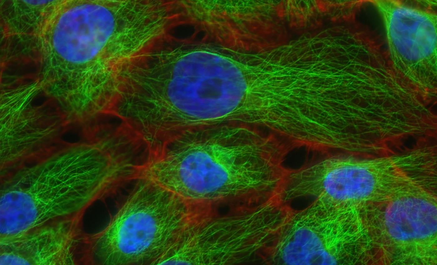 Enterococcus faecalis bacteria causes prostate cancer.