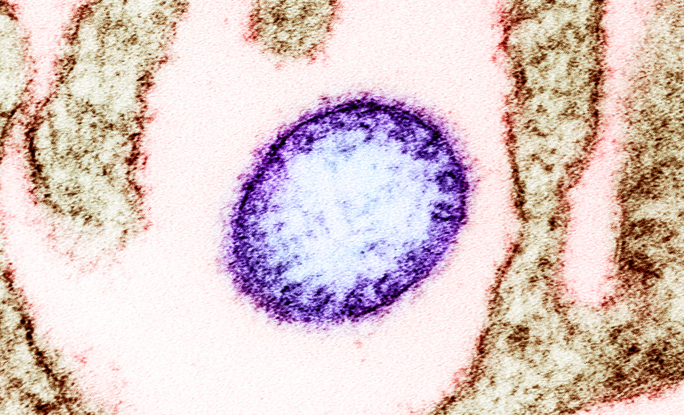 Nipah virus infection has the same symptoms as COVID-19.