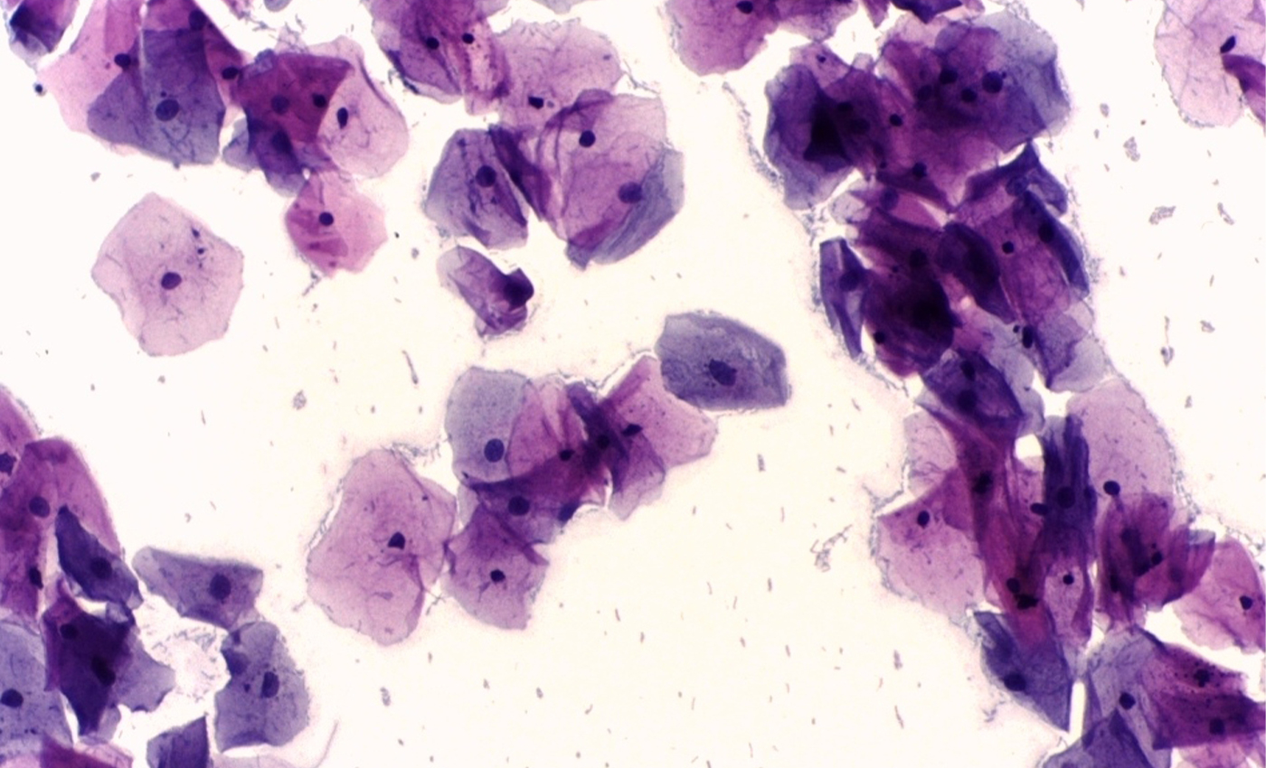 Pap smears cause HPV.