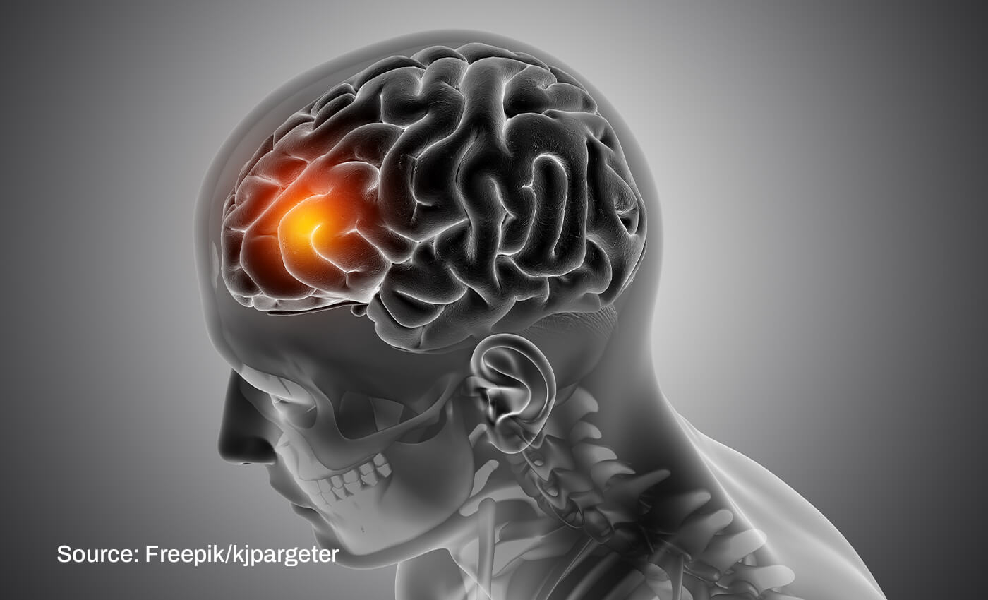 COVID-19 vaccines cause intracranial hemorrhage.