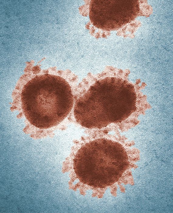 A new symptom of novel coronavirus infection is frostbite.