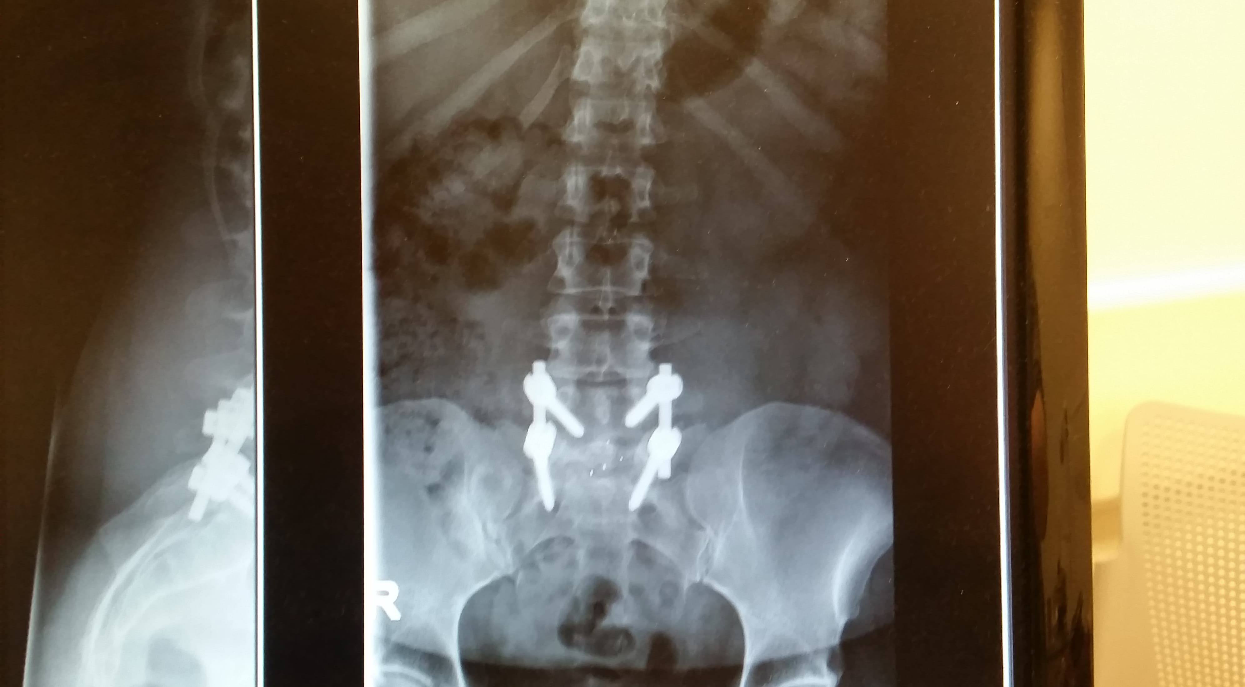 Rebuilding my life after spinal surgery The Chesed Fund